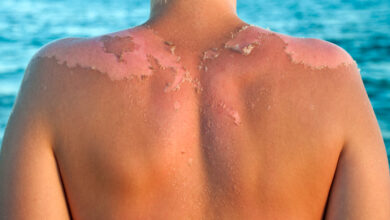 ماهي حروق الشمس وأنواعها ؟ وكيف يمكن علاجها؟ 1 Clarity Sun Damage blog