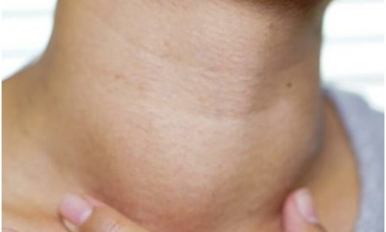 قصور الغدة الدرقية ، أسبابه ، أعراضه