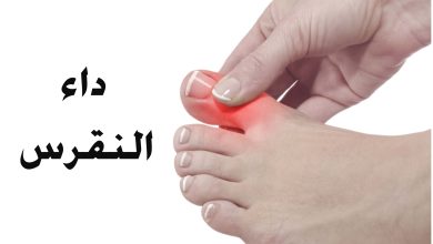 مرض النقرس ، أسبابه ، أعراضه ، الاطعمة الممنوعة على مريض النقرس 24 مرض النقرس ، أسبابه ، أعراضه ، الاطعمة الممنوعة على مريض النقرس