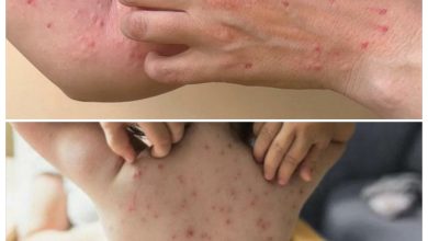 كل ماتريد معرفته عن الوباء الجديد ، جدري القرود 23 كل ماتريد معرفته عن الوباء الجديد ، جدري القرود